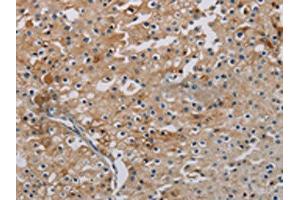 The image on the left is immunohistochemistry of paraffin-embedded Human prostate cancer tissue using ABIN7191864(PHKA2 Antibody) at dilution 1/30, on the right is treated with synthetic peptide. (PHKA2 anticorps)