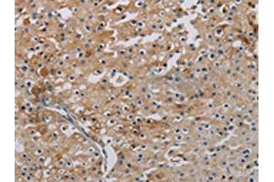 The image on the left is immunohistochemistry of paraffin-embedded Human prostate cancer tissue using ABIN7191864(PHKA2 Antibody) at dilution 1/30, on the right is treated with synthetic peptide. (PHKA2 anticorps)