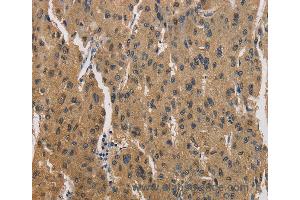 Immunohistochemistry of Human liver cancer using CKMT2 Polyclonal Antibody at dilution of 1:60 (CKMT2 anticorps)