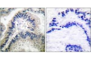 Immunohistochemistry analysis of paraffin-embedded human lung carcinoma tissue, using Guanylate Cyclase beta Antibody. (GUCYB anticorps  (AA 10-59))