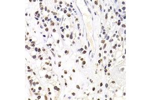 Immunohistochemistry of paraffin-embedded human kidney cancer using SOX5 antibody at dilution of 1:100 (x400 lens). (SOX5 anticorps)