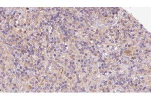 ABIN6273099 at 1/100 staining Human lymph cancer tissue by IHC-P. (CHCHD6 anticorps  (Internal Region))