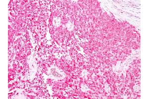 Formalin-fixed, paraffin-embedded human Melanoma stained with S100B Mouse Monoclonal Antibody (4C4.