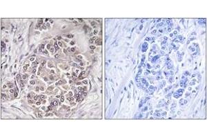 Immunohistochemistry analysis of paraffin-embedded human breast carcinoma tissue, using PEX1 Antibody. (PEX1 anticorps  (AA 1234-1283))