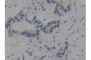 Detection of HMGB1 in Human Breast cancer Tissue using Polyclonal Antibody to High Mobility Group Protein 1 (HMGB1) (HMGB1 anticorps  (AA 9-163))