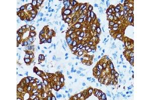 Immunohistochemistry of paraffin-embedded Human gastric cancer using CTSE Polyclonal Antibody at dilution of 1:100 (40x lens). (Cathepsin E anticorps)