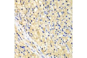 Immunohistochemistry of paraffin-embedded human lung cancer using NUP62 antibody.