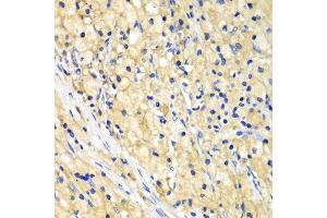 Immunohistochemistry of paraffin-embedded human lung cancer using NUP62 antibody. (NUP62 anticorps  (AA 403-522))