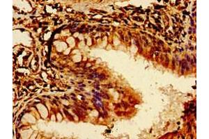 Immunohistochemistry of paraffin-embedded human lung cancer using ABIN7174072 at dilution of 1:100 (ROR2 anticorps  (AA 752-926))