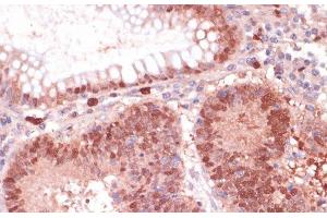 Immunohistochemistry of paraffin-embedded Human colon carcinoma using S100P Polyclonal Antibody at dilution of 1:100 (40x lens). (S100P anticorps)