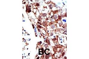 Formalin-fixed and paraffin-embedded human cancer tissue reacted with the primary antibody, which was peroxidase-conjugated to the secondary antibody, followed by AEC staining. (PIAS2 anticorps  (C-Term))
