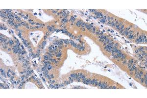 Immunohistochemistry of paraffin-embedded Human colon cancer tissue using GDF11 Polyclonal Antibody at dilution 1:30 (GDF11 anticorps)