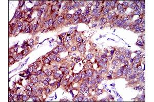 Immunohistochemical analysis of paraffin-embedded esophageal cancer tissues using SLC27A2 mouse mAb with DAB staining.