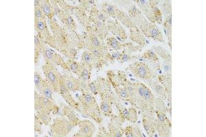 Immunohistochemistry of paraffin-embedded human liver injury using HSD17B13 Antibody. (HSD17B13 anticorps  (AA 20-300))