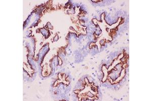 Anti-MUC1 Picoband antibody,  IHC(P): Human Ovary Cancer Tissue