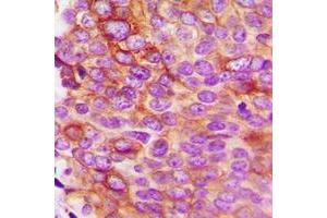 Immunohistochemical analysis of IL-5 staining in human breast cancer formalin fixed paraffin embedded tissue section. (IL-5 anticorps  (Center))