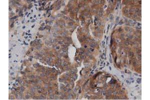 Immunohistochemical staining of paraffin-embedded Adenocarcinoma of Human breast tissue using anti-DNAJA2 mouse monoclonal antibody. (DNAJA2 anticorps)