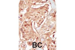 Formalin-fixed and paraffin-embedded human cancer tissue reacted with PCTK3 polyclonal antibody  , which was peroxidase-conjugated to the secondary antibody, followed by DAB staining. (CDK18 anticorps  (N-Term))