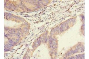 Immunohistochemistry of paraffin-embedded human endometrial cancer using ABIN7166096 at dilution of 1:100