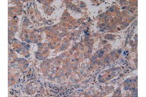 IHC-P analysis of Human Breast Cancer Tissue, with DAB staining. (CD40 anticorps  (AA 26-187))