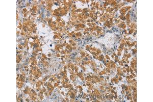 Immunohistochemistry of Human cervical cancer using DIDO1 Polyclonal Antibody at dilution of 1:60 (DIO1 anticorps)