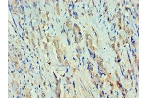 Immunohistochemistry of paraffin-embedded human colon cancer using ABIN7150384 at dilution of 1:100 (RFX5 anticorps  (AA 367-616))