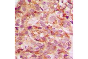 Immunohistochemical analysis of Collagen 5 alpha 3 staining in human breast cancer formalin fixed paraffin embedded tissue section.