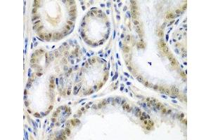 Immunohistochemistry of paraffin-embedded Human colon carcinoma using SSX2 Polyclonal Antibody at dilution of 1:200 (40x lens). (SSX2 anticorps)