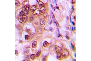Immunohistochemical analysis of p27 Kip1 (pT187) staining in human breast cancer formalin fixed paraffin embedded tissue section.
