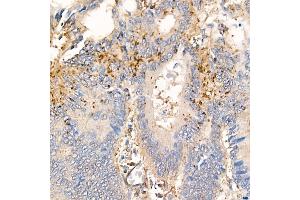 Immunohistochemistry of paraffin-embedded human colon carcinoma using MMP7 Rabbit mAb (ABIN7268425) at dilution of 1:150 (40x lens). (MMP7 anticorps)