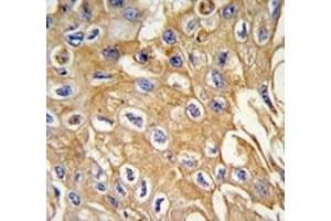 IHC analysis of FFPE human lung carcinoma tissue stained with RIPK3 antibody