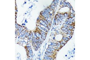 Immunohistochemistry of paraffin-embedded human colon carcinoma using TNF Rabbit mAb (ABIN7271076) at dilution of 1:100 (40x lens).