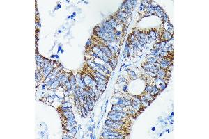 Immunohistochemistry of paraffin-embedded human colon carcinoma using TNF Rabbit mAb (ABIN7271076) at dilution of 1:100 (40x lens). (TNFAIP3 anticorps)
