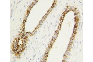 Caspase-1 antibody testing of human breast cancer tissue by IHC-P.