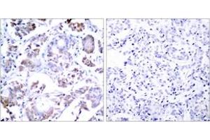 Immunohistochemistry analysis of paraffin-embedded human breast carcinoma tissue, using NF-kappaB p65 (Ab-254) Antibody. (NF-kB p65 anticorps  (AA 221-270))
