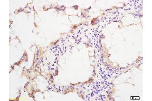 Formalin-fixed and paraffin embedded human rectal carcinoma labeled with Rabbit Anti phospho-SHC(Ser36) Polyclonal Antibody, Unconjugated (ABIN745913) at 1:200 followed by conjugation to the secondary antibody and DAB staining