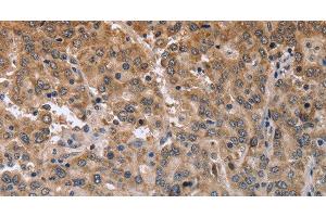 Immunohistochemistry of paraffin-embedded Human liver cancer using MAPRE3 Polyclonal Antibody at dilution of 1:50 (MAPRE3 anticorps)