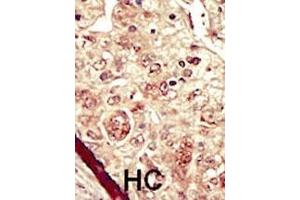 Formalin-fixed and paraffin-embedded human cancer tissue reacted with the primary antibody, which was peroxidase-conjugated to the secondary antibody, followed by DAB staining.
