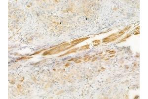 ABIN6257061 and ABIN6274183 at 1/100 staining human tongue carcinoma by IHC-P. (CKMT2 anticorps  (Internal Region))