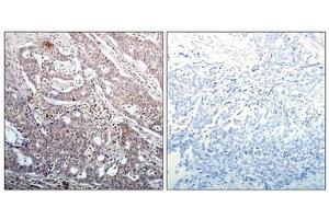 Immunohistochemical analysis of paraffin-embedded human breast carcinoma tissue using IkB-b(Phospho-Ser23) Antibody(left) or the same antibody preincubated with blocking peptide(right). (NFKBIB anticorps  (pSer23))