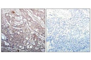 Immunohistochemical analysis of paraffin-embedded human breast carcinoma tissue using IkB-b(Phospho-Ser23) Antibody(left) or the same antibody preincubated with blocking peptide(right).