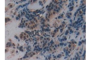 Detection of FZD1 in Human Breast cancer Tissue using Polyclonal Antibody to Frizzled Homolog 1 (FZD1) (FZD1 anticorps  (AA 117-322))