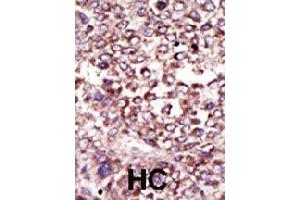 Formalin-fixed and paraffin-embedded human hepatocellular carcinoma tissue reacted with RPN2 polyclonal antibody  , which was peroxidase-conjugated to the secondary antibody, followed by DAB staining . (Ribophorin II anticorps  (N-Term))