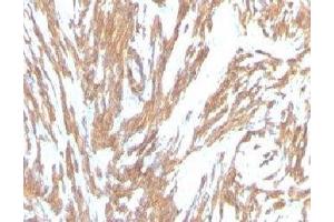 Formalin-fixed, paraffin-embedded human Leiomyosarcoma stained with alpha Smooth Muscle Actin antibody (ACTA2/791). (Smooth Muscle Actin anticorps)