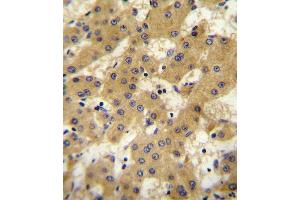 OF antibody (Center) 10107c immunohistochemistry analysis in formalin fixed and paraffin embedded human hepatocarcinoma followed by peroxidase conjugation of the secondary antibody and DAB staining.