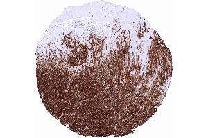 Dog1 Tumor periphery of a GIST showing intensive DOG1 staining in all tumor cells