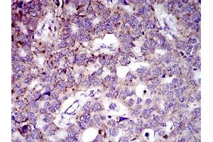 Immunohistochemical analysis of paraffin-embedded esophageal cancer tissues using MRPL42 mouse mAb with DAB staining. (MRPL42 anticorps  (AA 10-142))