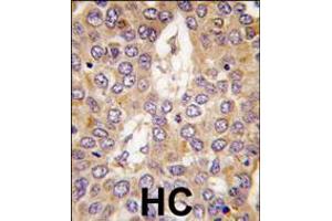 Formalin-fixed and paraffin-embedded human hepatocarcinoma tissue reacted with CK1g2 antibody , which was peroxidase-conjugated to the secondary antibody, followed by DAB staining. (Casein Kinase 1 gamma 2 anticorps  (C-Term))