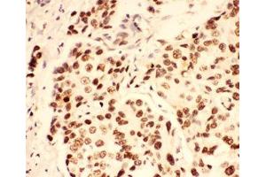 IHC-P: BRCA1 antibody testing of human breast cancer tissue (BRCA1 anticorps  (AA 1661-1863))