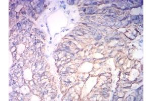 Immunohistochemical analysis of paraffin-embedded colon cancer tissues using KRT19 mouse mAb with DAB staining.